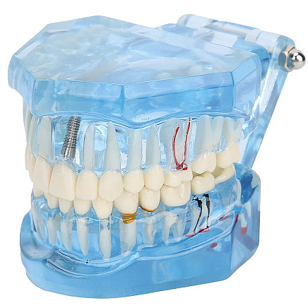 Dental model jaw teeth teeth implants