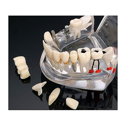 Dental model jaw teeth teeth implants