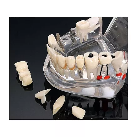 Dental model jaw teeth teeth implants