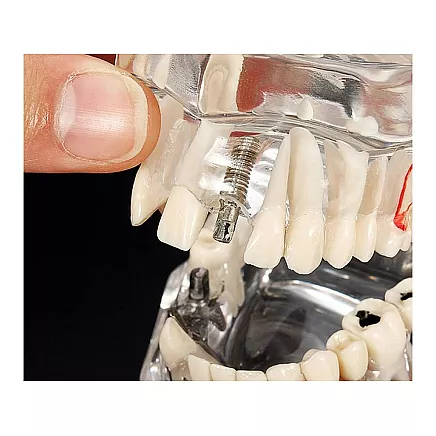 Dental model jaw teeth teeth implants