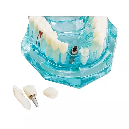 Dental model jaw teeth teeth implants