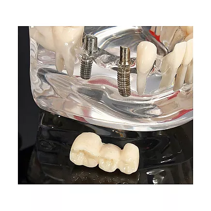 Dental model jaw teeth teeth implants