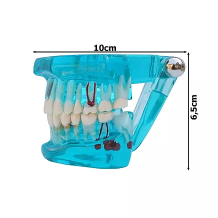 Dental model jaw teeth teeth implants