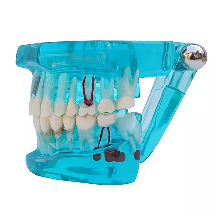 Dental model jaw teeth teeth implants