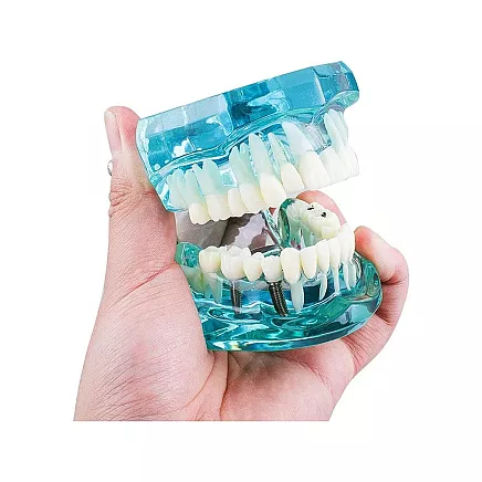 Dental model jaw teeth teeth implants